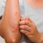 Skin Itching Causes & Treatment: চুলকানির কারণ ও দূর করার ঘরোয়া সহজ উপায়