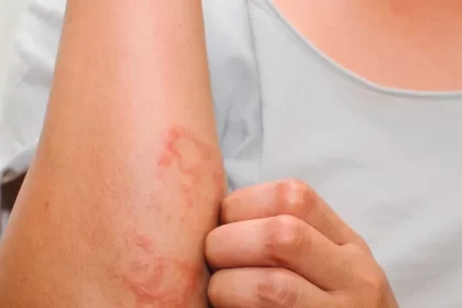 Skin Itching Causes & Treatment: চুলকানির কারণ ও দূর করার ঘরোয়া সহজ উপায়